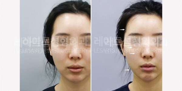 얼굴지방이식 전후사진 - 레아트성형외과