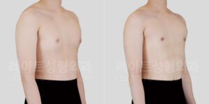 여유증 수술 전후 비교 사진 레아트 성형외과