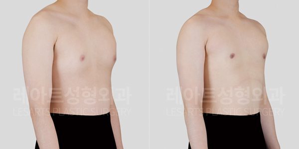 여유증 수술 전후 비교 사진 레아트 성형외과