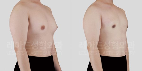 여유증 수술 전후 비교 사진 - 레아트 성형외과