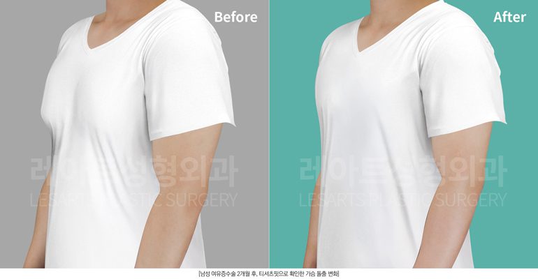 여유증 수술 전후 옷핏 비교 레아트성형외과