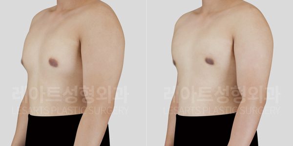 여유증 수술 전후 비교 반측면 모습 - 레아트 성형외과