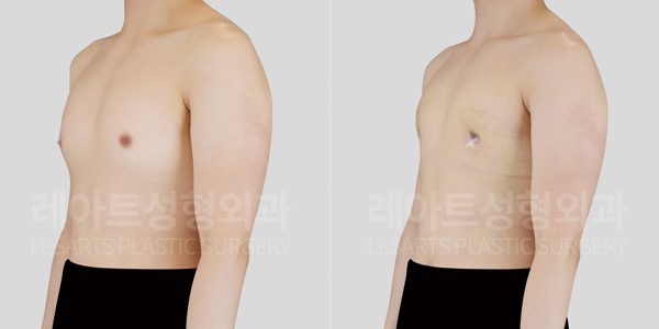 여유증 수술 전후 비교모습 - 레아트 성형외과