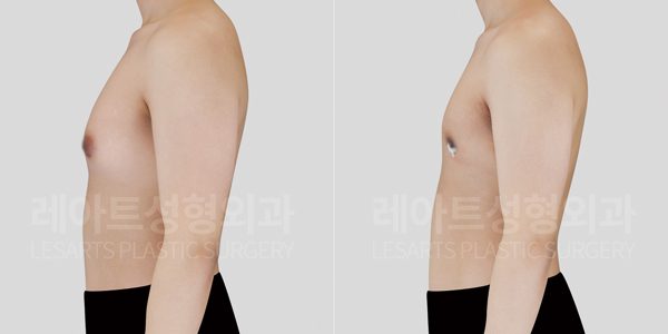 여유증 수술 전후사진 레아트 성형외과