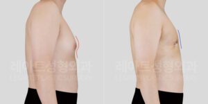 여유증 수술 전후사진 - 레아트 성형외과