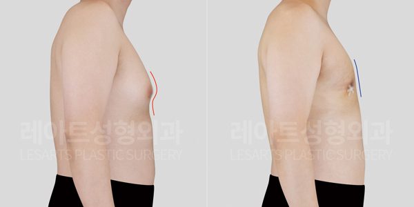 여유증 수술 전후사진 - 레아트 성형외과