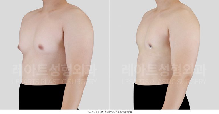 여유증 전후사진 반측면