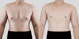 살찌면 여유증 생길까? 레아트성형외과 남자 가슴 돌출 수술 2주 변화