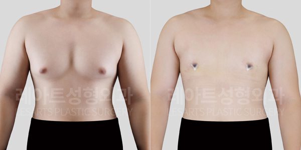 살찌면 여유증 생길까? 레아트성형외과 남자 가슴 돌출 수술 2주 변화