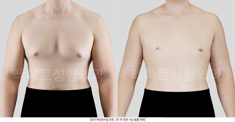 여유증 전후사진 레아트 성형외과
