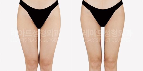 허벅지 지방흡입 | 절대 빠지지 않는 허벅지 안쪽살, 지방흡입 2주 후 변화