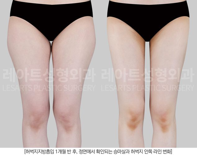 허벅지 지방흡입 레아트 성형외과