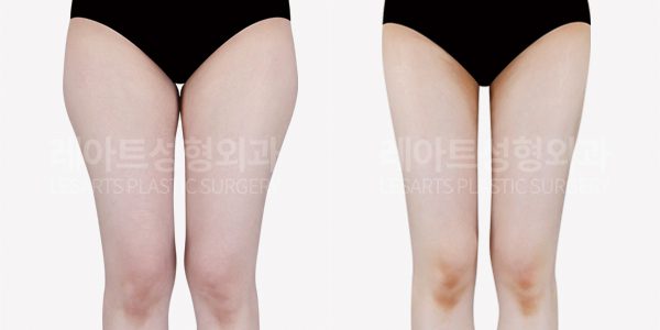허벅지지방흡입 전후사진 레아트 성형외과