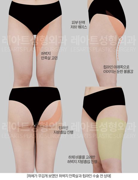 허벅지지방흡입 수술전 플랜