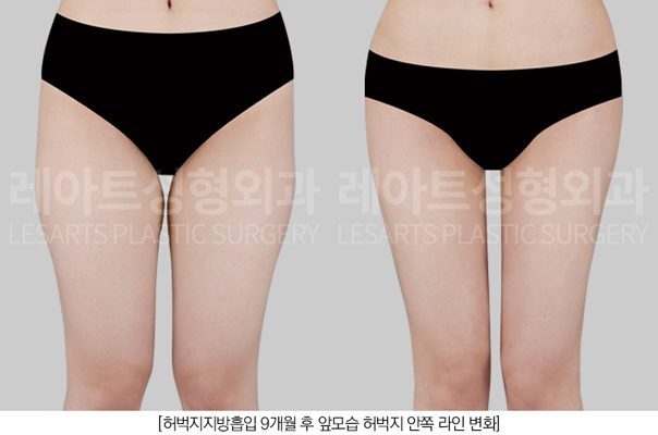 허벅지 지방흡입 전후비교 모습