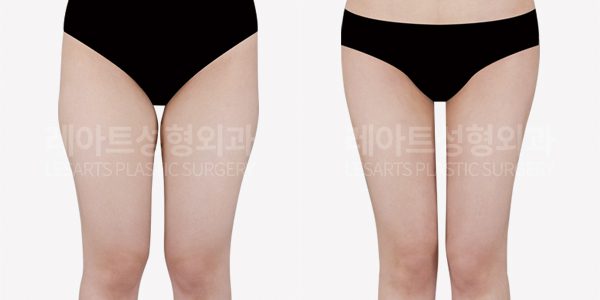 다리가 길어지는 허벅지지방흡입 방법 – 압구정 레아트 성형외과