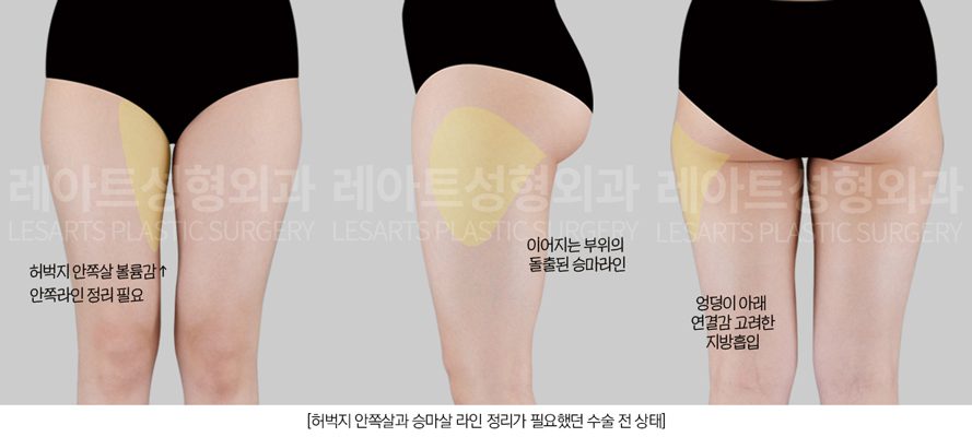 허벅지지방흡입 수술전 플랜