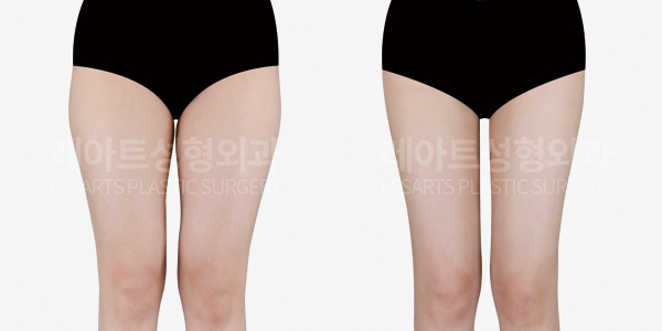 허벅지 살빼기 고민, 허벅지지방흡입으로 해결하기 (전후 비교)