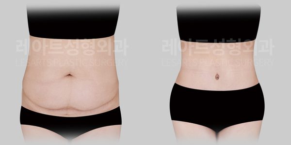 복부거상수술 전후사진 레아트 성형외과