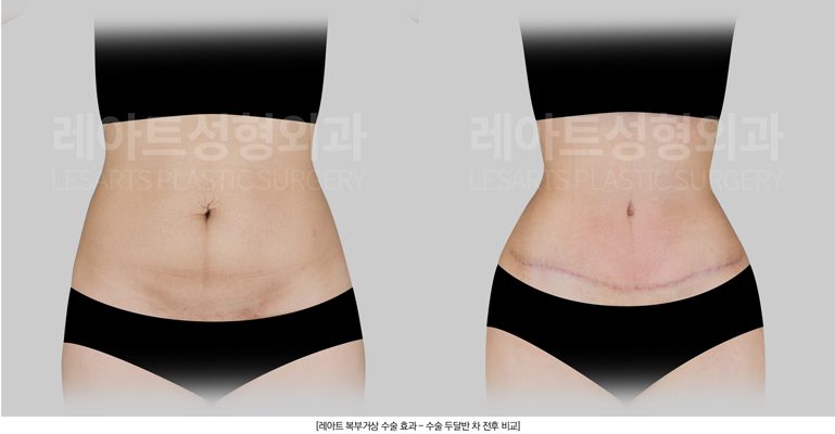 복부거상수술  | 제왕절개흉터 위로 접히던 아랫배, 복부거상수술 2달반 후 변화