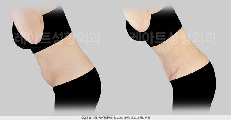 복부거상 전후사진 - 밴딩 모습