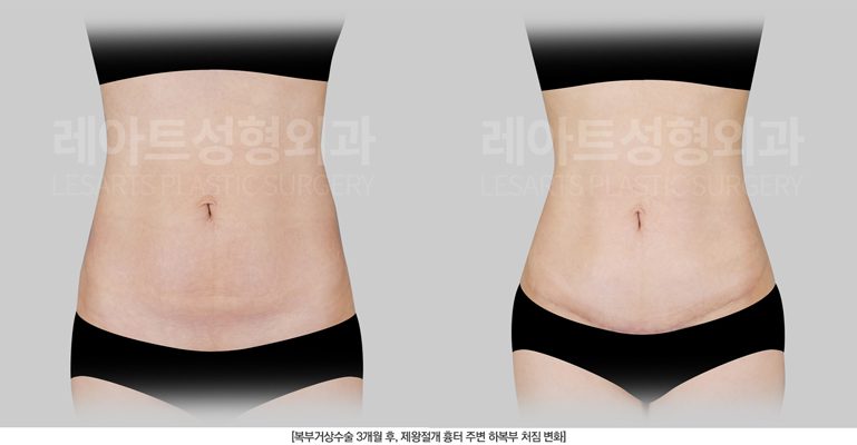 복부거상 전후사진 앞모습