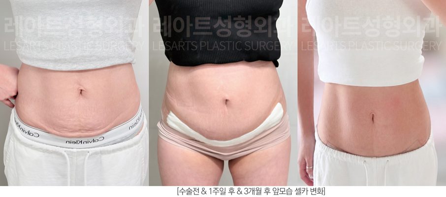 복부거상술 전후 경과에 따른 셀카 사진