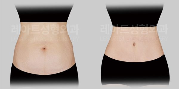 복부거상수술 전후 비교사진 - 레아트 성형외과
