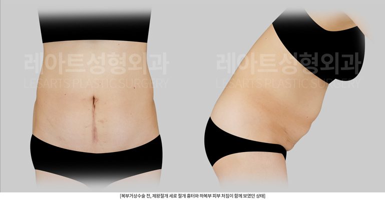 복부거상수술 전후사진 세로절개흉터 제거 - 레아트 성형외과