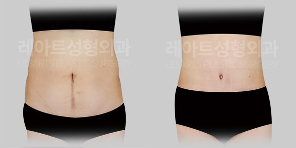 복부거상수술 전후사진 - 레아트 성형외과