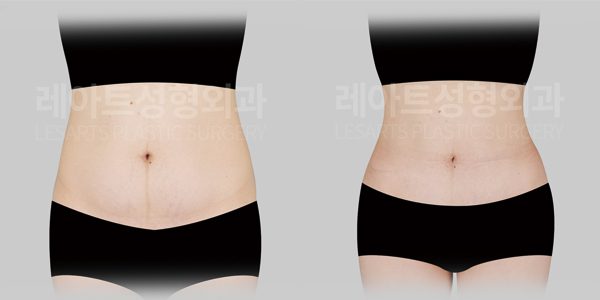 복부거상 전후사진 - 레아트 성형외과