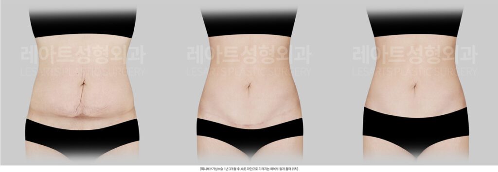 복부거상 수술 경과별 변화