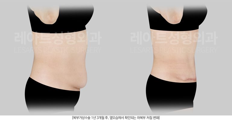 복부거상 전후사진 레아트 성형외과