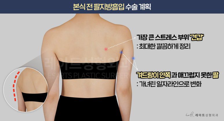 상체 지방흡입 수술 방법-레아트성형외과 서용승원장