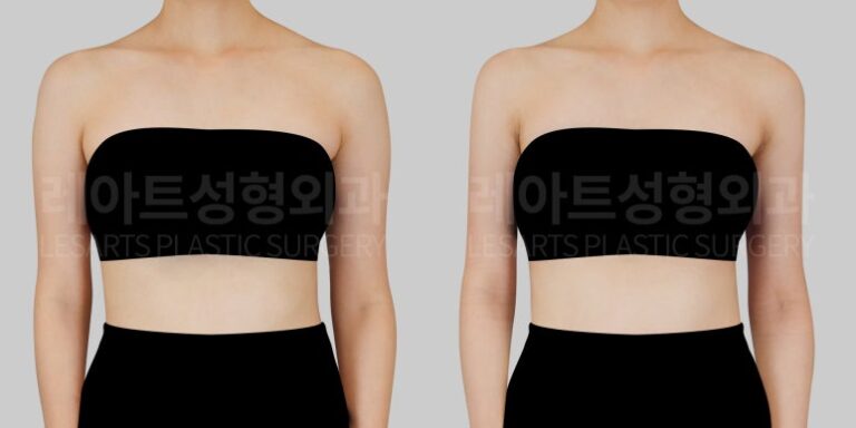 결혼 전 상체 다이어트 - 레아트성형외과 서용승원장