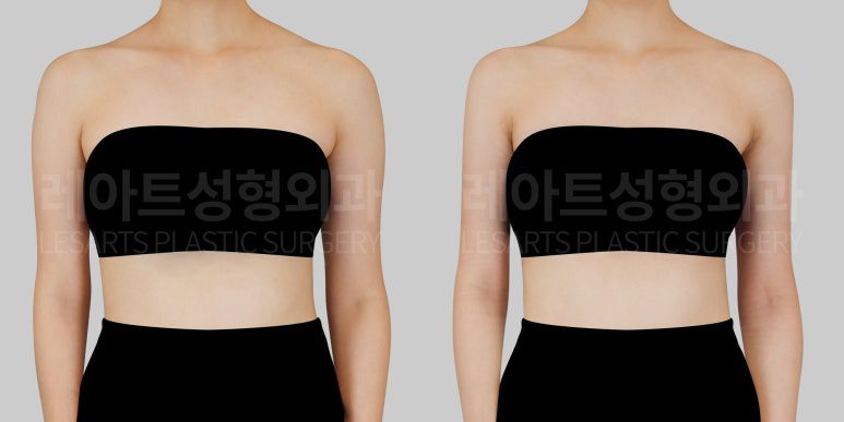결혼 전 상체 다이어트 - 레아트성형외과 서용승원장