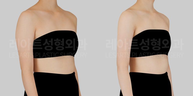 팔 뒷볼록 지방흡입 전후 차이 - 레아트 서용승 원장