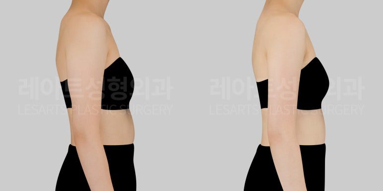 팔지방흡입 후 라인 변화 - 레아트 서용승 원장