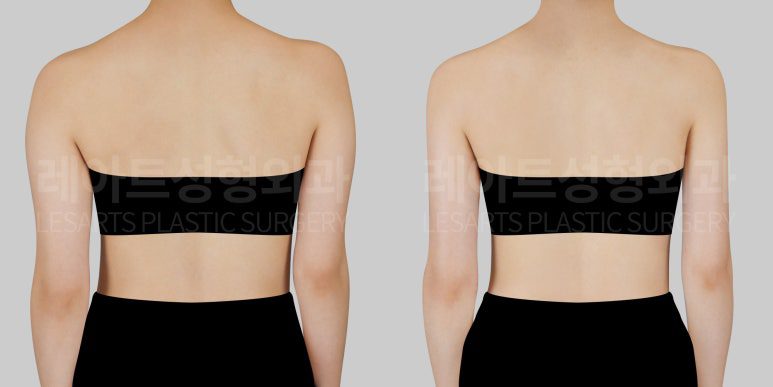 예비신부 팔, 등(견갑) 지방흡입 - 레아트 성형외과 서용승 원장