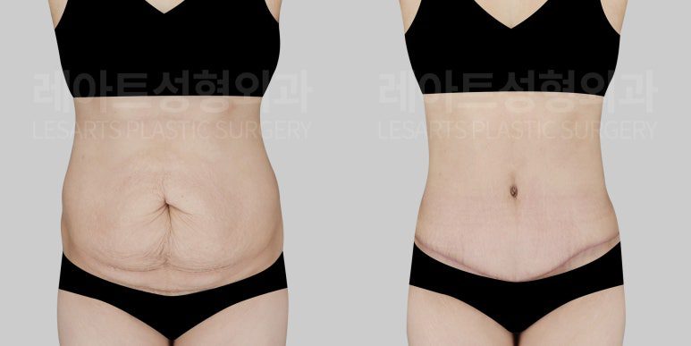 복부 지방흡과 복부거상을 병행한 케이스 - 레아트 성형외과