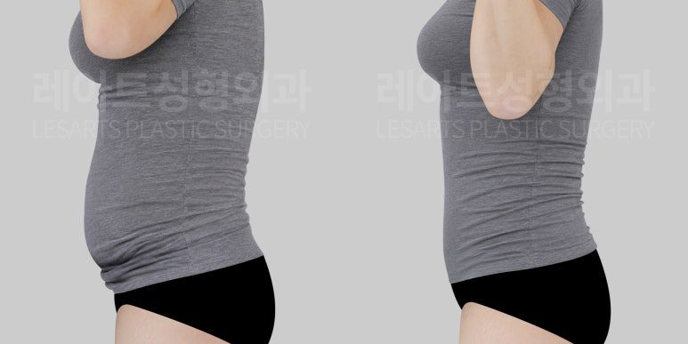 복부거상 전후 옷핏 모습 - 레아트성형외과