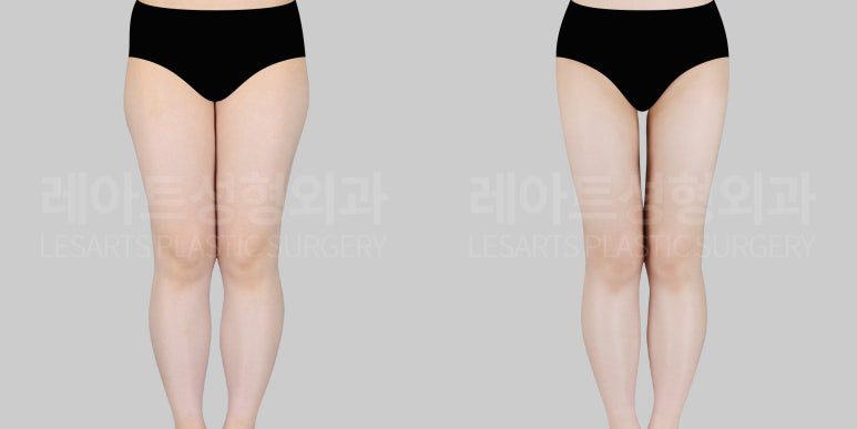 c-thigh-liposuction-post27-01