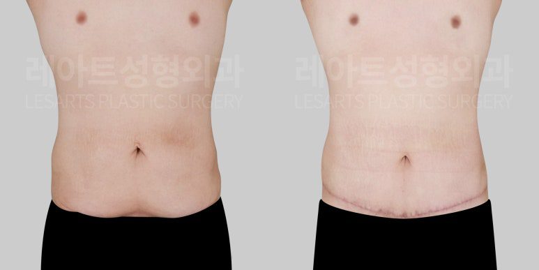 남자 복부거상술 전후 비교 사진 - 레아트 성형외과