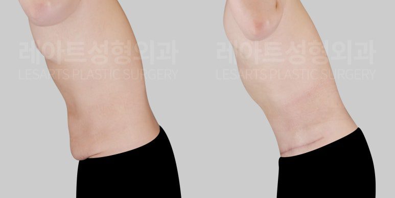 남자 복부거상술 전후 측면 모습 쳐진 뱃살 교정 - 레아트 성형외과