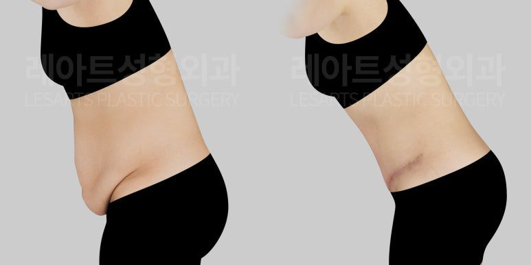 복부거상 3개월 후 전후 옆모습 비교