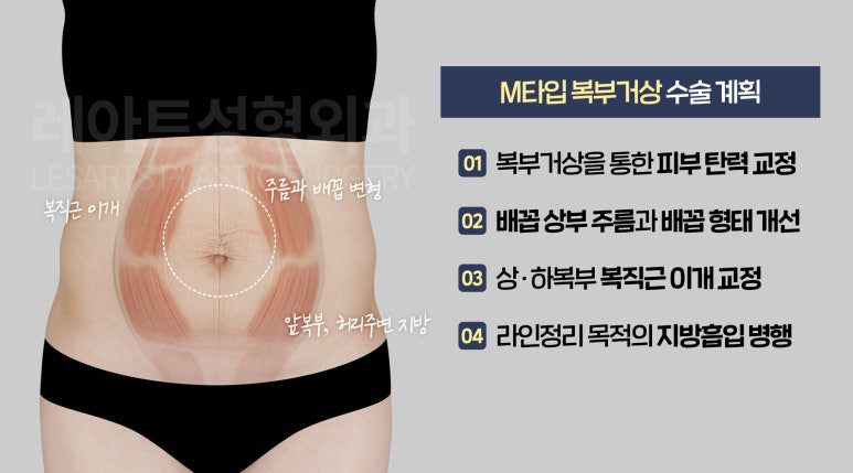 M타입 전체 복부거상 계획