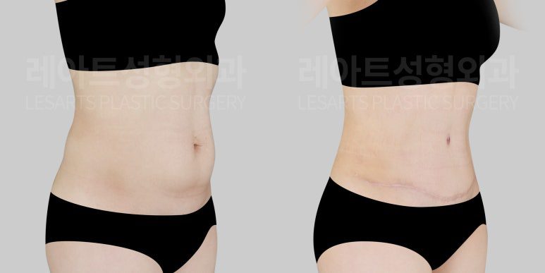복부거상 전후 모습 - 레아트 성형외과