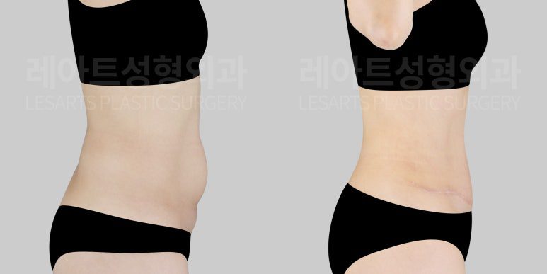 복부거상, 복부지방흡입 7개월 경과