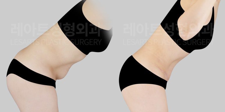 복부거상술로 처진 아랫배 교정 - 레아트 성형외과