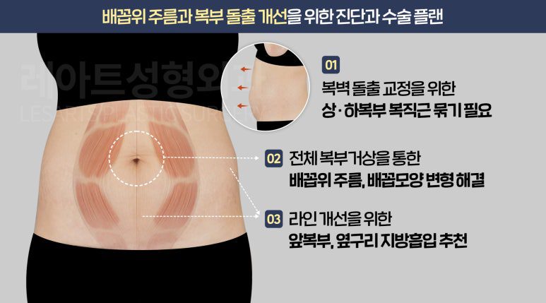 l-abdominoplasty-post28-01